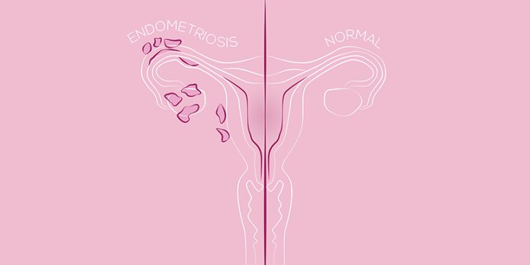 endometriosis easing painful sex