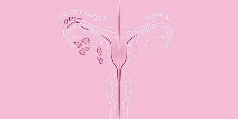 endometriosis easing painful sex