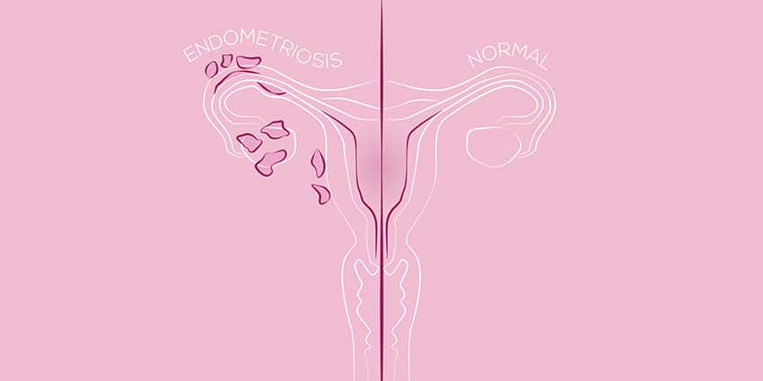 endometriosis easing painful sex